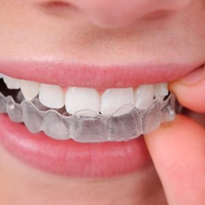 Invisalign & Invisible Braces Sydney