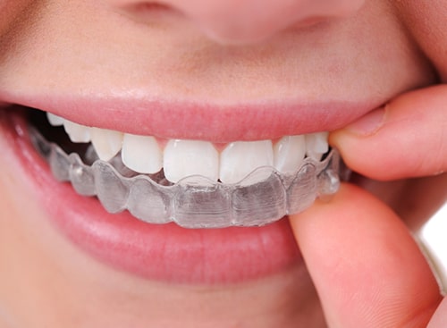 Invisalign & Invisible Braces Sydney