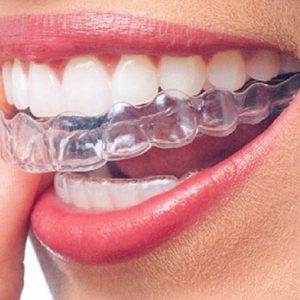 Invisalign Sydney: What you need to know