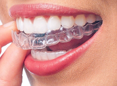 How Invisalign Can Improve Your Smile