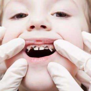 Avoiding Baby Bottle Tooth Decay