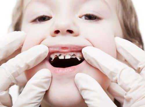 Avoiding Baby Bottle Tooth Decay