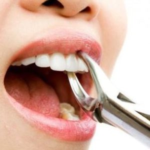 Reasons to Consult Parramatta Professional For Wisdom Teeth Removal