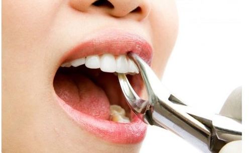 Reasons to Consult Parramatta Professional For Wisdom Teeth Removal