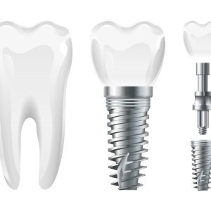 Dental Implant and Dentures Parramatta