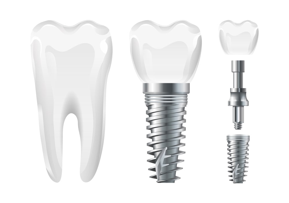 Dental Implant and Dentures Parramatta