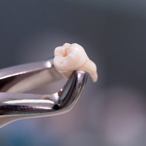Wisdom Teeth Removal Parramatta