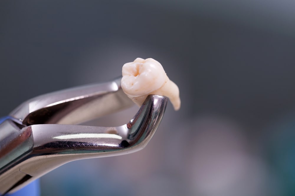 Wisdom Teeth Removal Parramatta