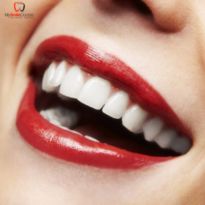 How to care for your teeth during holidays