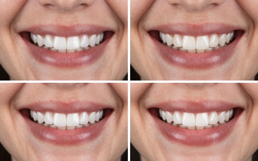 Before and after smile transformation showing cosmetic dentistry results