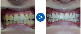 mysmiledoctor_teeth2