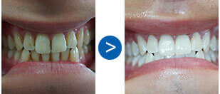 mysmiledoctor_teeth3